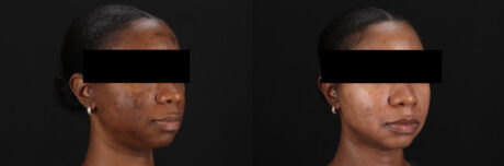 Cosmelan Chemical Peel case #5075