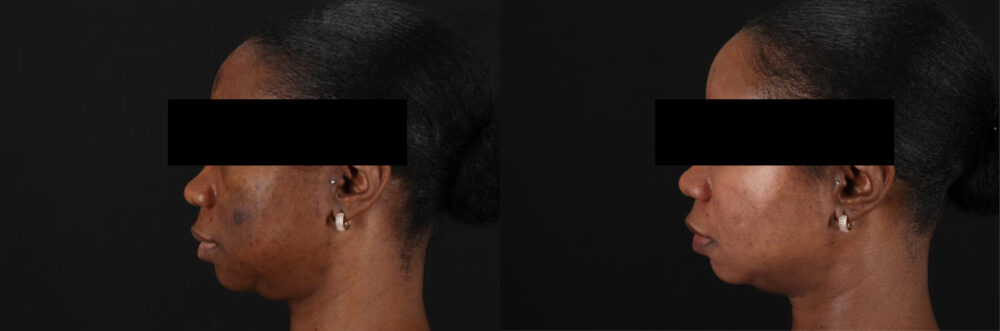 Cosmelan Chemical Peel case #5075