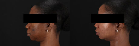 Cosmelan Chemical Peel case #5075