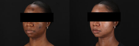 Cosmelan Chemical Peel case #5075