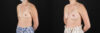 Breast Augmentation case #6371 slider thumbnail