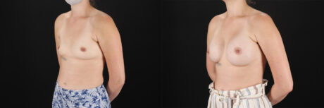 Breast Augmentation case #6371