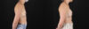 Breast Augmentation case #6371 slider thumbnail