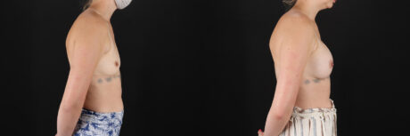Breast Augmentation case #6371