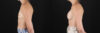 Breast Augmentation case #6371 slider thumbnail