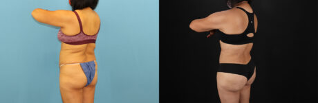 Tummy Tuck case #7458