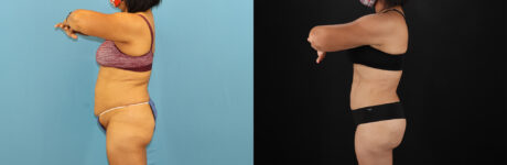 Tummy Tuck case #7458