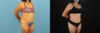 Tummy Tuck case #7458 slider thumbnail