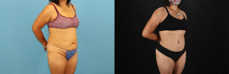 Tummy Tuck case #7458