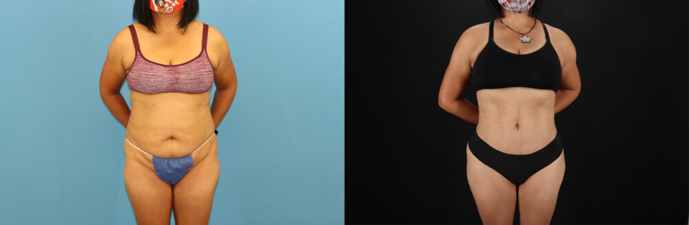 Tummy Tuck case #7458