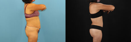 Tummy Tuck case #7458
