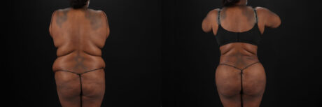 Tummy Tuck case #7353