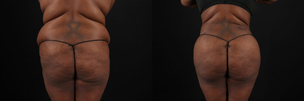 Tummy Tuck case #7353