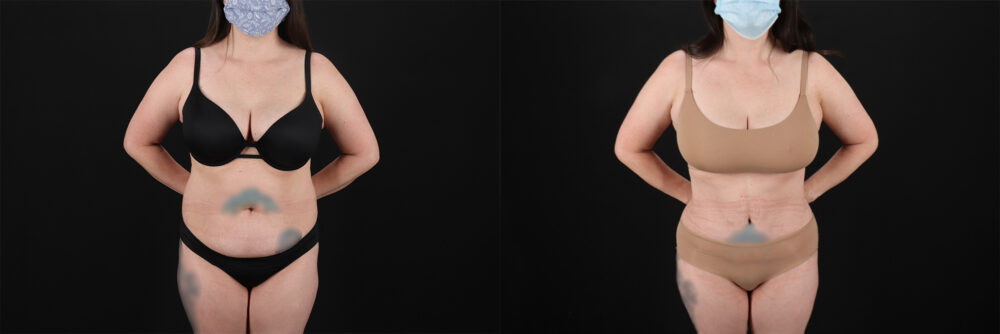 Tummy Tuck case #7460