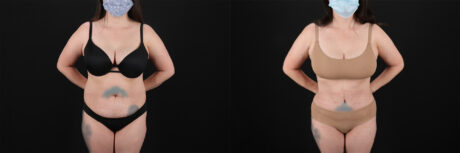 Tummy Tuck case #7460