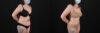 Tummy Tuck case #7460 slider thumbnail