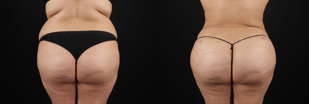 Brazilian Butt Lift case #5266