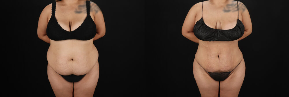 Brazilian Butt Lift case #5266