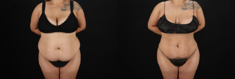 Brazilian Butt Lift case #5266