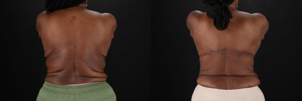 Post Bariatric Surgery (Massive Weight Loss) case #6781
