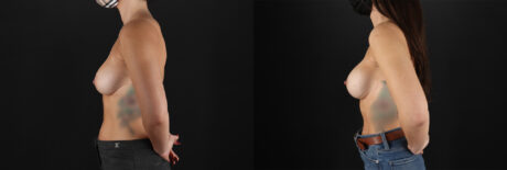 Breast Augmentation case #6378