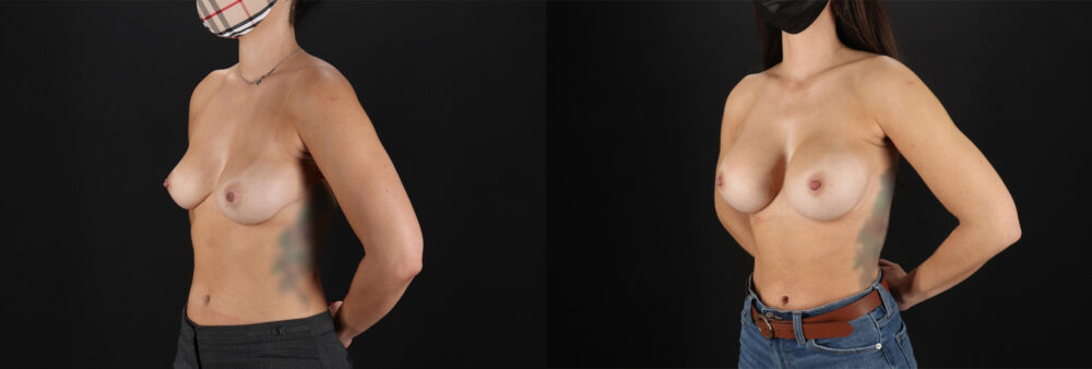 Breast Augmentation case #6378