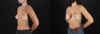 Breast Augmentation case #6378 slider thumbnail