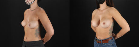 Breast Augmentation case #6378