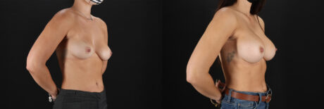 Breast Augmentation case #6378