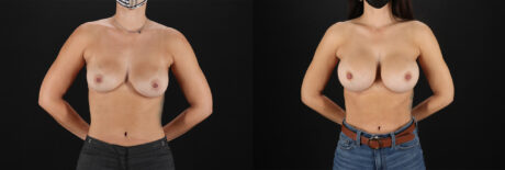 Breast Augmentation case #6378