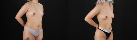 Liposuction case #6020