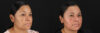 Cosmelan Chemical Peel case #5081 slider thumbnail