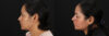 Cosmelan Chemical Peel case #5081 slider thumbnail