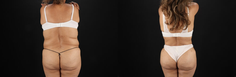 Liposuction case #6111