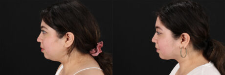 Submental Liposuction case #6953