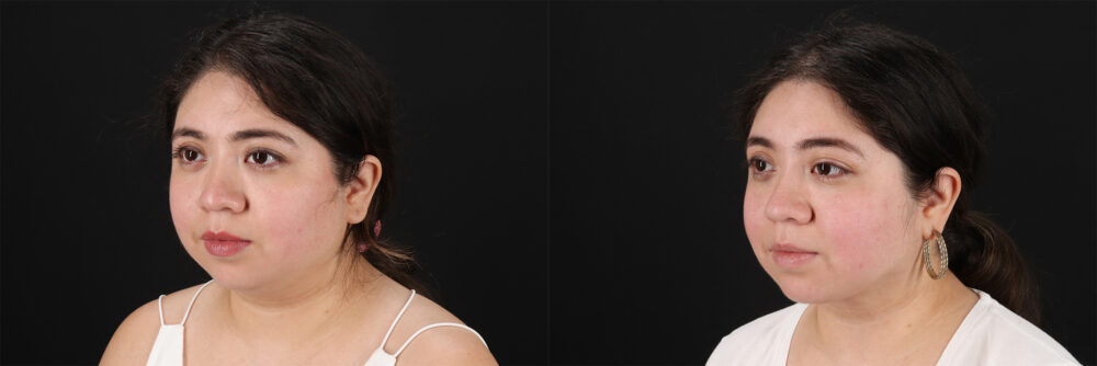 Submental Liposuction case #6953