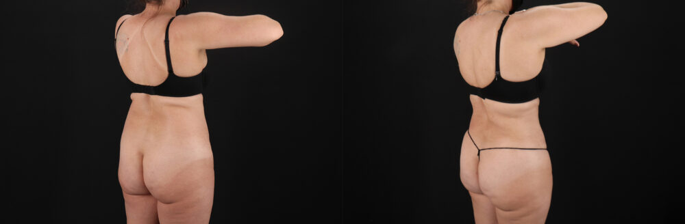 Liposuction case #6112