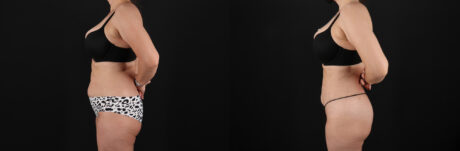 Liposuction case #6112