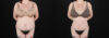 Liposuction case #6019 slider thumbnail