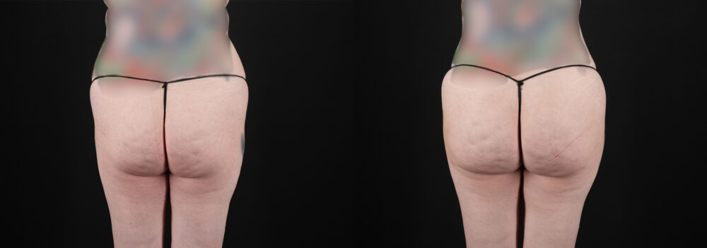 Liposuction case #6019