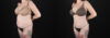 Liposuction case #6019 slider thumbnail