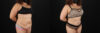 Tummy Tuck case #7467 slider thumbnail
