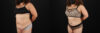 Tummy Tuck case #7467 slider thumbnail