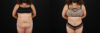 Tummy Tuck case #7467 slider thumbnail
