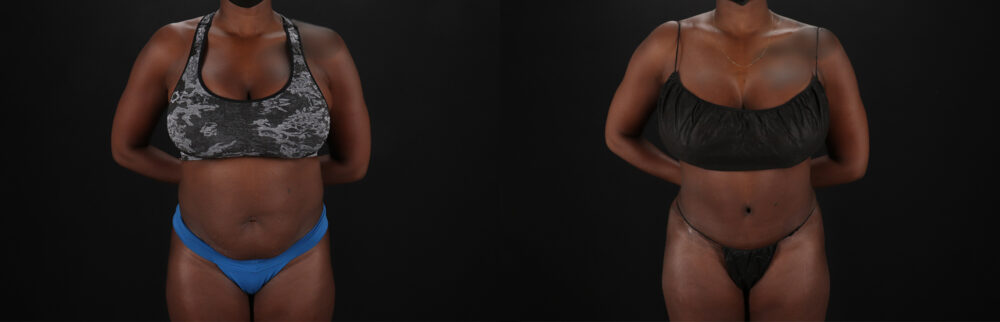 Tummy Tuck case #7466