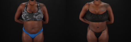 Tummy Tuck case #7466