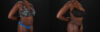 Tummy Tuck case #7466 slider thumbnail