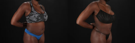 Tummy Tuck case #7466