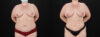 Liposuction case #6117 slider thumbnail