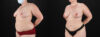 Liposuction case #6117 slider thumbnail